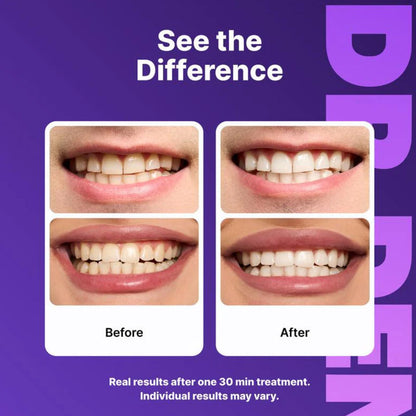 Dr. Dent Purple Teeth Whitening Strips - Fast Results, Zero Sensitivity FREE