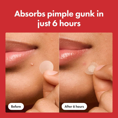 Hero Cosmetics - #1 Hydrocolloid Acne Pimple Patches for Face, Shrinking Zits & Whiteheads in 1 Use, Nighttime Spot Pimple Stickers for Face